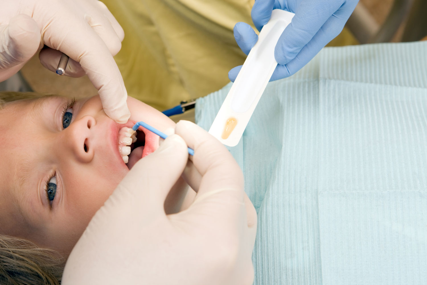 The photo shows the filling procedure of a little girl's tooth